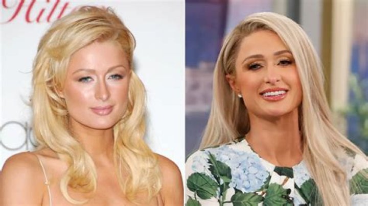 Kathy Hilton Nose Job A Promise Of Transformation