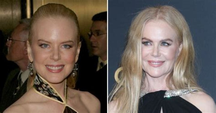 Nicole Kidman Cosmetic Surgery: Exploring the Transformations of a Hollywood Icon