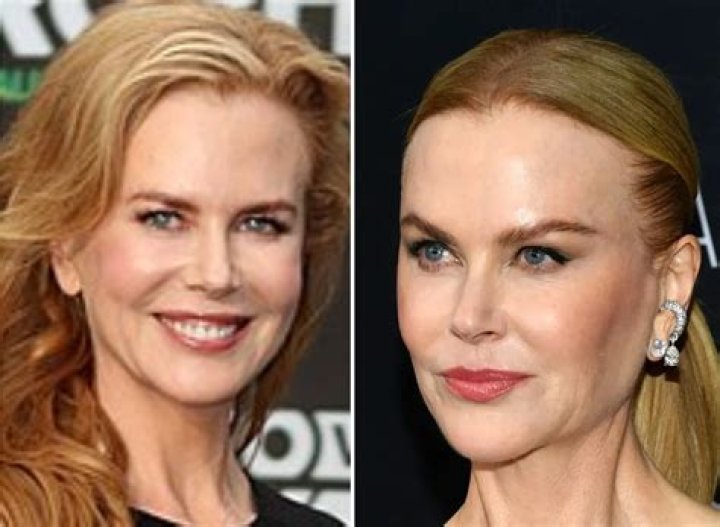 Nicole Kidman Plastic Surgery: A Comprehensive Analysis of Her Transformation Over the Years