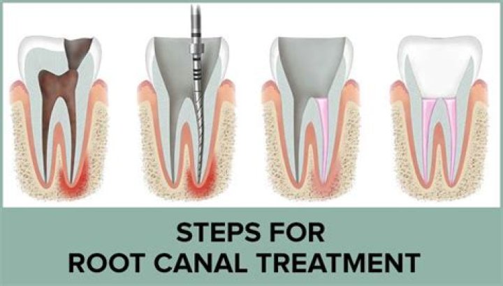 Root Canal Treatment for Top Molar: Everything You Need to Know