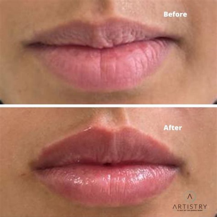 Suni Lee Lip Fillers: Everything You Need to Know About the Popular Aesthetic Treatment