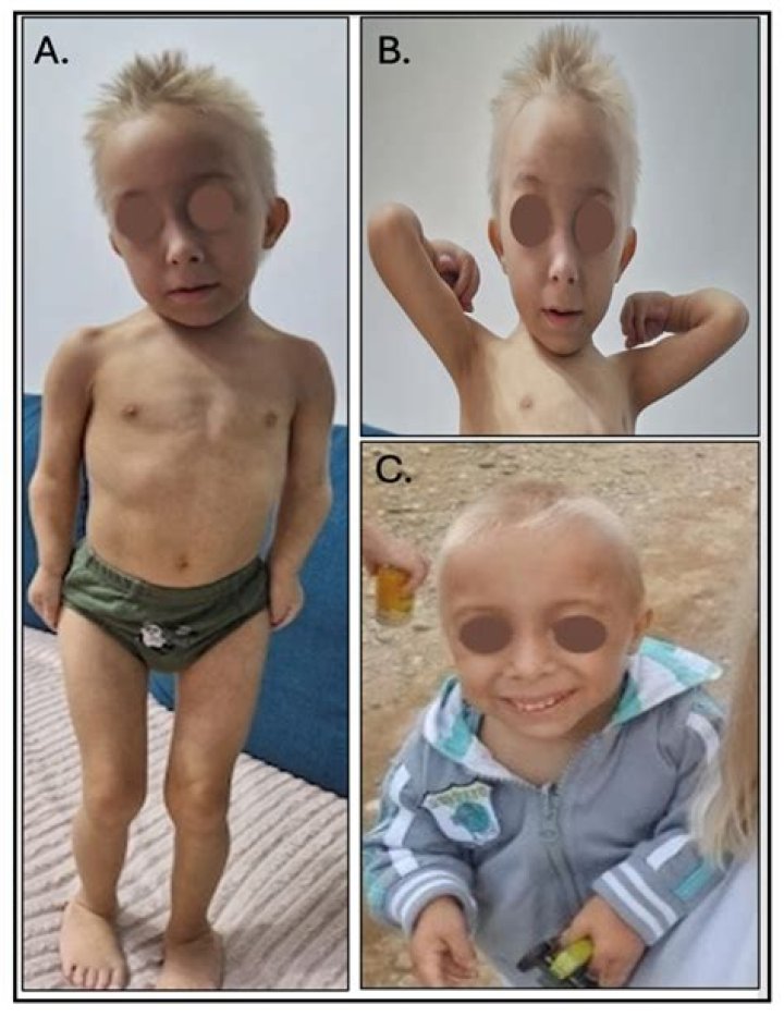 Unraveling The Enigma Of Shayna Dwarfism: Discoveries And Insights