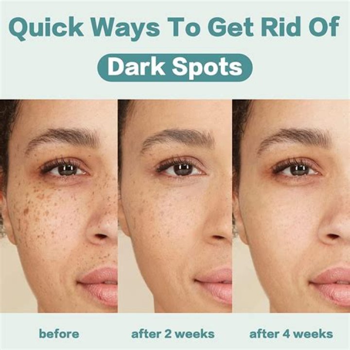 Unveiling The Best Dark Spot Correctors