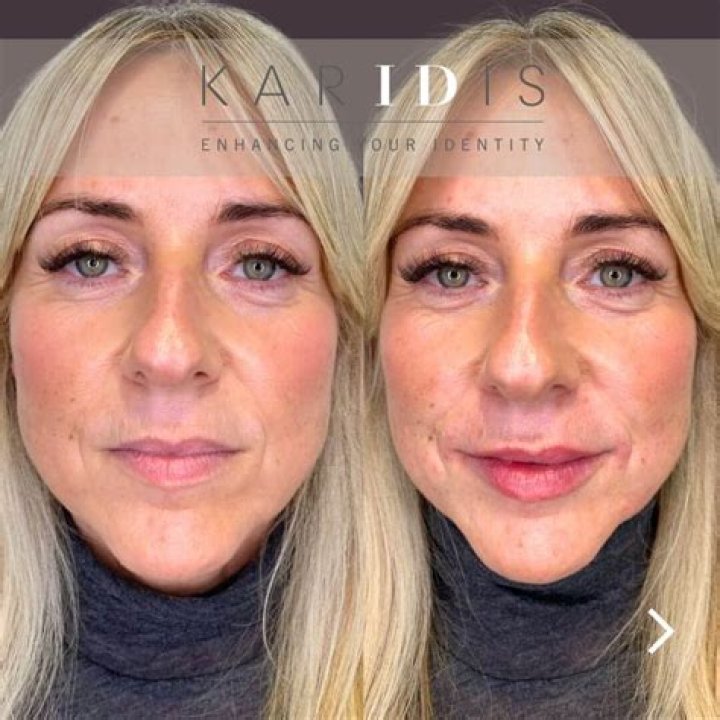 Unveiling The Truth Behind Kylie Jenner's Lip Filler Removal: Discoveries And Insights